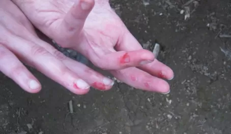 Steph\'s injured fingers